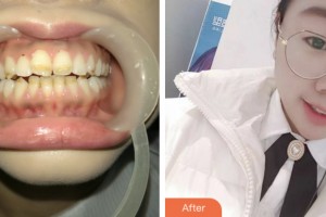 昆山禾豐口腔醫(yī)院周昌浩整形價格表附美白貼片案例展示