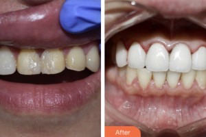 昆山禾豐口腔醫(yī)院丁載雄整形價格表附牙貼面案例展示