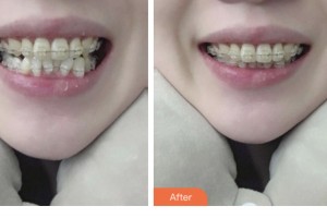 昆山益達(dá)口腔門診部浦海亞整形價格表附美白貼片案例展示