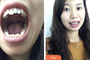 昆山益達(dá)口腔門診部徐恒整形價格表附金屬托槽矯正案例展示