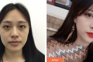 齊齊哈爾千百度整形美容醫(yī)院張俠整形價格表附眼部綜合案例展示