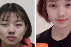 齊齊哈爾醫(yī)學(xué)院附屬第三醫(yī)院醫(yī)療美容科李云峰整形價格表附切開雙眼皮案例展示