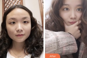 齊齊哈爾千百度整形美容醫(yī)院佟彤整形價格表附切開雙眼皮案例展示