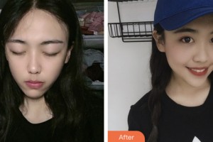 齊齊哈爾千百度整形美容醫(yī)院姜欣整形價格表附眼部綜合案例展示