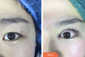 齊齊哈爾愛爾眼科醫(yī)院張焱整形價格表附眼部綜合案例展示