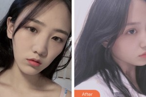 齊齊哈爾千百度整形美容醫(yī)院李鳳浩整形價格表附切開雙眼皮案例展示