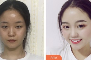 齊齊哈爾君悅醫(yī)療美容醫(yī)院吳淑華整形價格表附眼部綜合案例展示