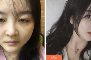 鹽城艾美莉整形美容醫(yī)院武崇高整形價格表附切開雙眼皮案例展示