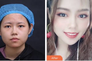 鹽城市第一人民醫(yī)院燒傷整形科刁永力整形價格表附眼部綜合案例展示