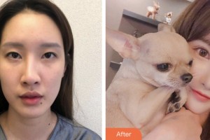 鹽城市第一人民醫(yī)院燒傷整形科葛乃航整形價格表附眼部綜合案例展示