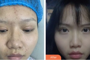 鹽城艾美莉整形美容醫(yī)院鄭基鎬整形價格表附眼部修復案例展示