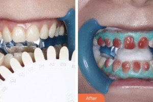 鹽城艾美莉整形美容醫(yī)院裔偉績整形價格表附美白劑美白牙齒案例展示