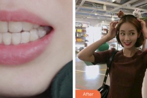 鹽城艾美莉整形美容醫(yī)院陳增喜整形價格表附超聲波潔牙案例展示