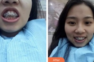 鹽城東方婦產醫(yī)院整形美容中心王武坤整形價格表附金屬托槽矯正案例展示