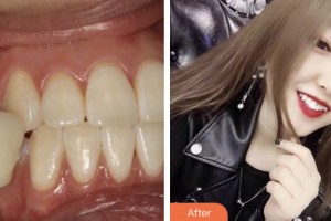 鹽城東方婦產醫(yī)院整形美容中心成潔整形價格表附冷光美白案例展示