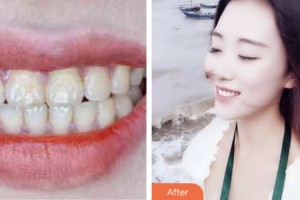 鹽城艾美莉整形美容醫(yī)院江月新住院醫(yī)師整形價格表附超聲波潔牙案例展示