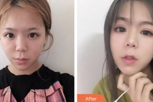 鹽城美得麗德整形美容門診部鄭在旭整形價格表附熱拉提案例展示