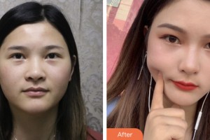 鹽城曙光愛爾眼科醫(yī)院程娟整形價格表附內切祛眼袋案例展示