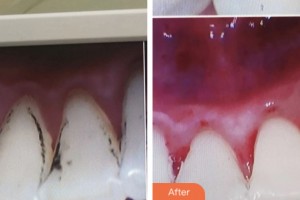 鹽城口腔醫(yī)院石開中整形價格表附超聲波潔牙案例展示