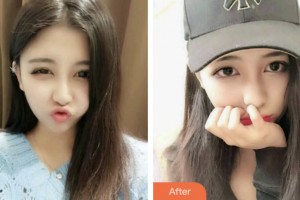 鹽城口腔醫(yī)院許海軍整形價格表附牙齒隱形矯正案例展示