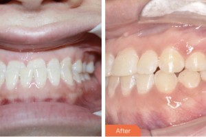 鹽城倍美永康口腔門診部張蓉整形價格表附金屬托槽矯正案例展示