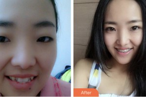 鹽城倍美永康口腔門診部洪瑛瑛住院醫(yī)師整形價格表附金屬托槽矯正案例展示