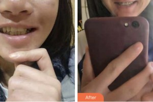 鹽城倍美永康口腔門診部李晶整形價格表附金屬托槽矯正案例展示