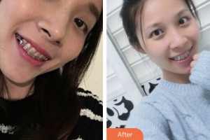 鹽城倍美永康口腔門診部陸鋒整形價格表附自鎖托槽矯正案例展示