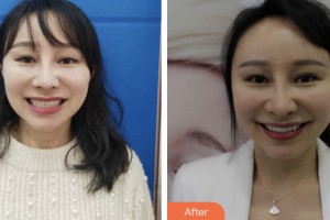 鹽城倍美永康口腔門診部浦寅飛整形價格表附牙貼面案例展示