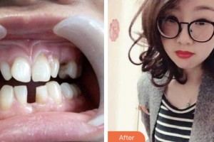 鹽城倍美永康口腔門診部唐士芹整形價格表附牙齒隱形矯正案例展示