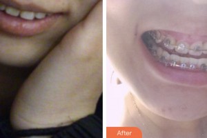 鹽城倍美永康口腔門診部仇靜靜整形價格表附金屬托槽矯正案例展示