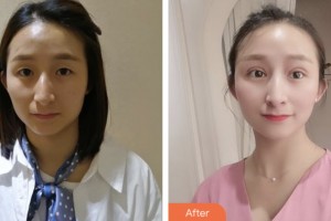 鹽城朝聚眼科醫(yī)院胡恩海整形價格表附切開雙眼皮案例展示