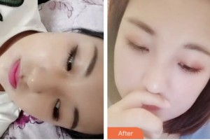 鹽城朝聚眼科醫(yī)院盧新華整形價格表附埋線雙眼皮案例展示