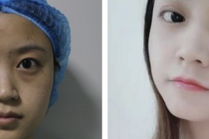 鹽城朝聚眼科醫(yī)院李春梅整形價格表附眼部綜合案例展示