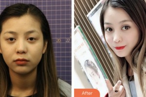 鹽城朝聚眼科醫(yī)院鄭晨超整形價格表附切開雙眼皮案例展示