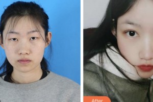 鹽城朝聚眼科醫(yī)院周羽整形價格表附眼部綜合案例展示