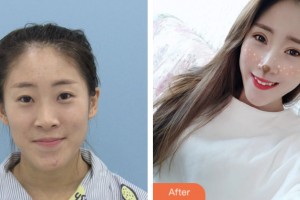 鹽城朝聚眼科醫(yī)院駱亞東整形價格表附眼部綜合案例展示