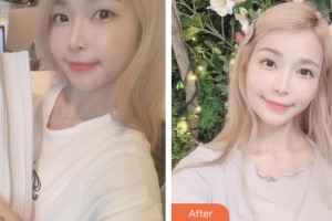 鹽城朝聚眼科醫(yī)院和大力整形價格表附切開雙眼皮案例展示