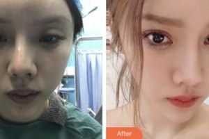 宿遷市人民醫(yī)院燒傷整形美容科王雪山整形價格表附切開雙眼皮案例展示