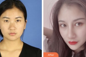 宿遷市人民醫(yī)院燒傷整形美容科徐業(yè)凱整形價格表附眼部綜合案例展示