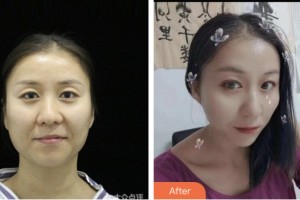 宿遷科以康愛爾五官醫(yī)院閆壽健整形價格表附眼部修復(fù)案例展示