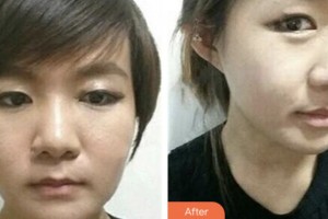 淮安市婦幼保健院醫(yī)療美容科徐剛整形價格表附埋線提升案例展示