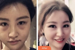 淮安第二人民醫(yī)院整形美容外科陳文斌整形價格表附內(nèi)切祛眼袋案例展示