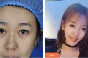 淮安市婦幼保健院醫(yī)療美容科余志芬整形價格表附切開雙眼皮案例展示