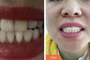 淮安市婦幼保健院醫(yī)療美容科郭嵩整形價格表附牙貼面案例展示