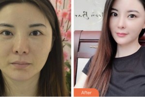 淮安俏美整形美容醫(yī)院李春江整形價格表附埋線提升案例展示