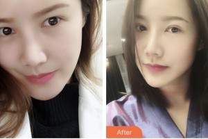 淮安愛(ài)爾眼科醫(yī)院肖耀廷整形價(jià)格表附切開(kāi)雙眼皮案例展示