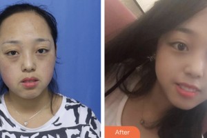 淮安愛(ài)爾眼科醫(yī)院張偉整形價(jià)格表附激光去眼袋案例展示