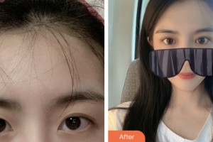 淮安光明眼科醫(yī)院李筱榮整形價(jià)格表附眼部綜合案例展示