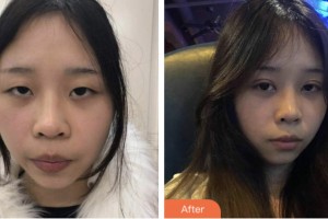 淮安光明眼科醫(yī)院宋建軍整形價(jià)格表附切開(kāi)雙眼皮案例展示